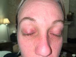 Any recommendations for treating eczema