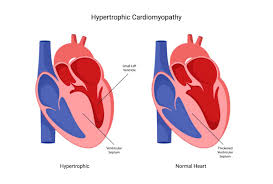 Image result for Cardiomyopathy