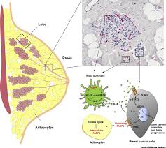 It can cause the breast to appear red and swollen, giving the appearance of inflammation. Fabp4 A New Player In Obesity Associated Breast Cancer Trends In Molecular Medicine