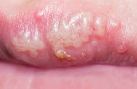 Find symptoms,causes and treatments of cold sore.for your health. Herpes Causes Symptoms And Treatment