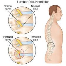 A herniated cervical disc occurs when one of the discs in the neck protrudes on a nearby nerve and causes pain.1 in this article we'll discuss this condition and give you how to do it: Lumbar Disc Herniation What You Need To Know