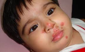Image result for yellow scabs on the face in children