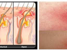 How do you get a boil on your buttocks. Causes Of Boils On Your Buttocks Enkimd