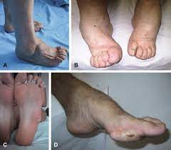 (sla), plus connue sous le nom de maladie de charcot. Dominant Charcot Marie Tooth Syndrome And Cognate Disorders Sciencedirect