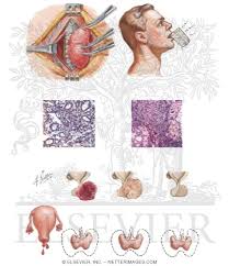 On the oral manifestations of hypothyroidism and the dental management for the same. Clinical Manifestations Of Hypothyroidism In Adults