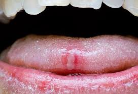 Sore Bumps On Tongue Lie Bumps Happen When Your Tongue Gets Irritated Tongue Sores Canker Sore Canker Sore On Tongue