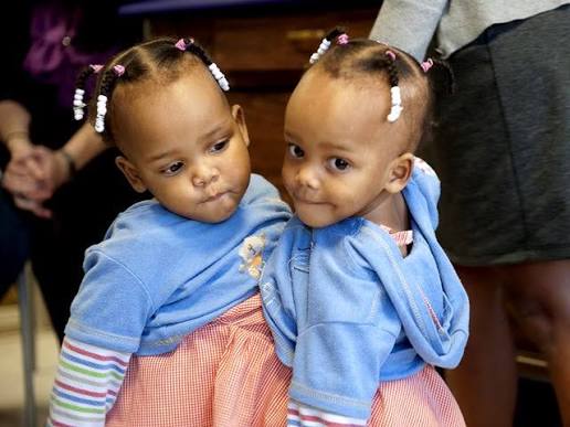 Conjoined twins Maria & Teresa Tapia: Before and after
