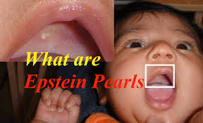 In addition, they can also appear as round or irregular shaped. What Are Epstein Pearls Explanation With Example Live Healthy