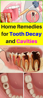 Home Remedies For Tooth Decay And Cavities Obsolo Teeth Rotting Tooth Decay Teeth Health