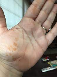 When im cold, my hands go really pale and sometimes blue. Rust Colored Splotches On Hands Babycenter