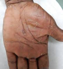 Image result for Secondary Syphilis