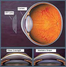 Ortho K Optimum Vision Care Brightonoptimum Vision Care