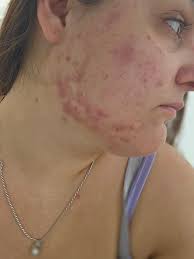 Please no negative comments , I have been dealing with acne my whole life  and nothing has ever worked. I have tried all types of products ranging  from sensative bar soap by