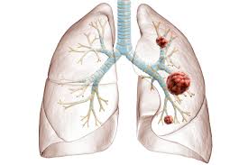 Image result for Lung Cancer