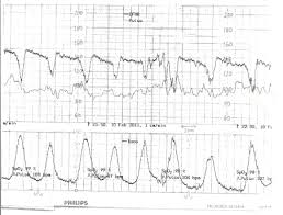 Image result for Late Deceleration