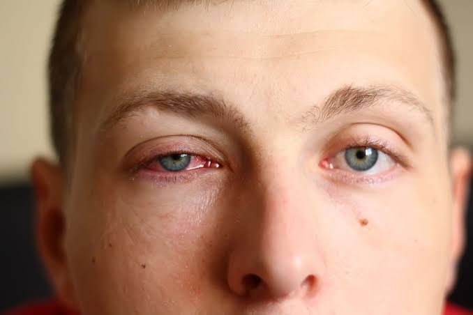 8 Causes of Crusty Eyes and How To Treat Them