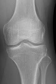 Image result for Tibia Stress Fracture