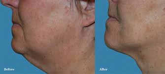 Morpheus8 skin tightening before and after photos. Everything You Need To Know About Facetite Amadi Aesthetics
