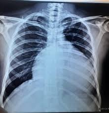 Image result for Chest XRay Interpretation
