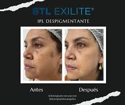 MUY PRONTO EN KINEGLAM CONCEPCIÓN!!!!🤗😍 BODYTITE