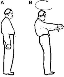 Image result for Ataxia