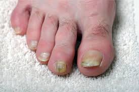 How To Use Baking Soda And Hydrogen Peroxide For Toenail Fungus