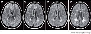 But many people look for other ways to feel better,. Magnims Consensus Guidelines On The Use Of Mri In Multiple Sclerosis Establishing Disease Prognosis And Monitoring Patients Nature Reviews Neurology