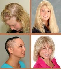 Check spelling or type a new query. Female Pattern Baldness Archives Arizona Wig Boutique