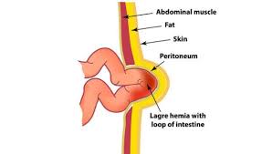 Koltuk Altynda Kist Ameliyaty
