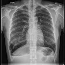 Image result for Pneumothorax