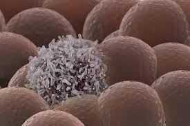 Find out all about carcinoma : Adenocarcinoma Types Symptoms And Causes