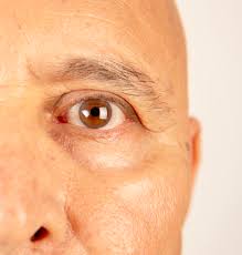 Image result for syphilis symptoms