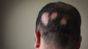 Image result for Alopecia