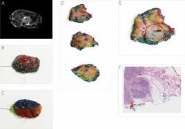 Sometimes, dense tissue can make it difficult to. Accuracy Of Gross Intraoperative Margin Assessment For Breast Cancer Experience Since The Sso Astro Margin Consensus Guidelines Scientific Reports