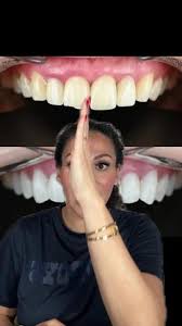 Midline Elastics And Canting - Youtube