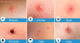 Maybe you would like to learn more about one of these? Picadura De Pulga En Humanos Complicaciones Picaduras De Pulga Linear Unit Humanos Como Identificarlas Y Tratarlas