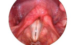 Image result for Reflux Laryngitis