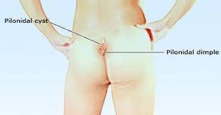 Image result for Pilonidal Cyst