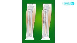Platin Hangi Durumda Ve Neden Takilir Youtube