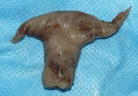 Uterine fibroids are noncancerous growths of the uterus that often appear during childbearing years. Heard Of A Decidual Cast A Doctor Shares The Causes And Cures