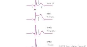 Mar 24, 2010 · unstable angina and nstemi: Nstemi Type 1 Or 2