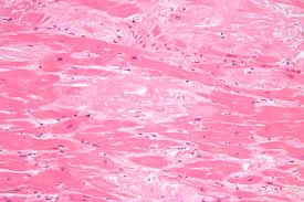 The gold standard for diagnosis of amyloidosis is histological analysis and congo red staining of biopsy specimens. File Cardiac Amyloidosis High Mag He Jpg Wikipedia