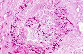 Mucormycosis refers to several different diseases caused by infection with fungi in the order of mucorales. Filamentous Fungi