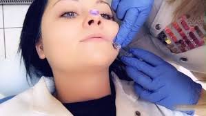 Povećanje volumena usana, sertifikovanim hijaluron filerima