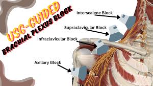 Image result for Axillary Nerve Block