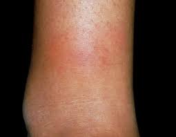 Around 30% of pregnant women develop palmar erythema. Skin Disease In Pregnancy Identifying And Treating Common And Rare Presentations Dermatology Advisor