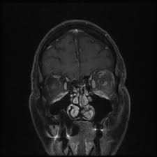 Lyme Disease With Erythema Migrans Presenting Concurrently With Optic Nerve Perineuritis And Abducens Nerve Palsy Bmj Case Reports