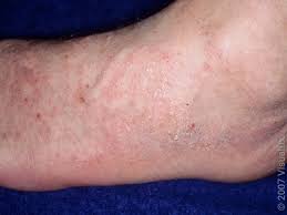 Image result for skin rash similar to scabies