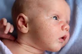 Image result for sweat rash on back baby