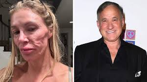 Dr. Terry Dubrow On Brandi's FaceBrandi Glanville Is In Talks With Dr.  Terry Dubrow About Her Disfigured Face: It's A "Ticking Time Bomb"